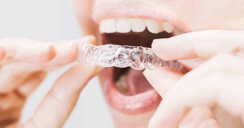 Know About the Difference Between Braces and Clear Aligners : Punhani Tooth  Care