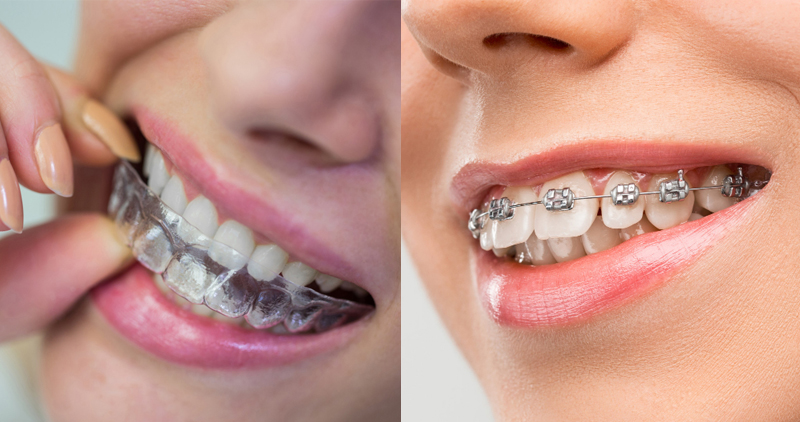 invisible aligners vs braces